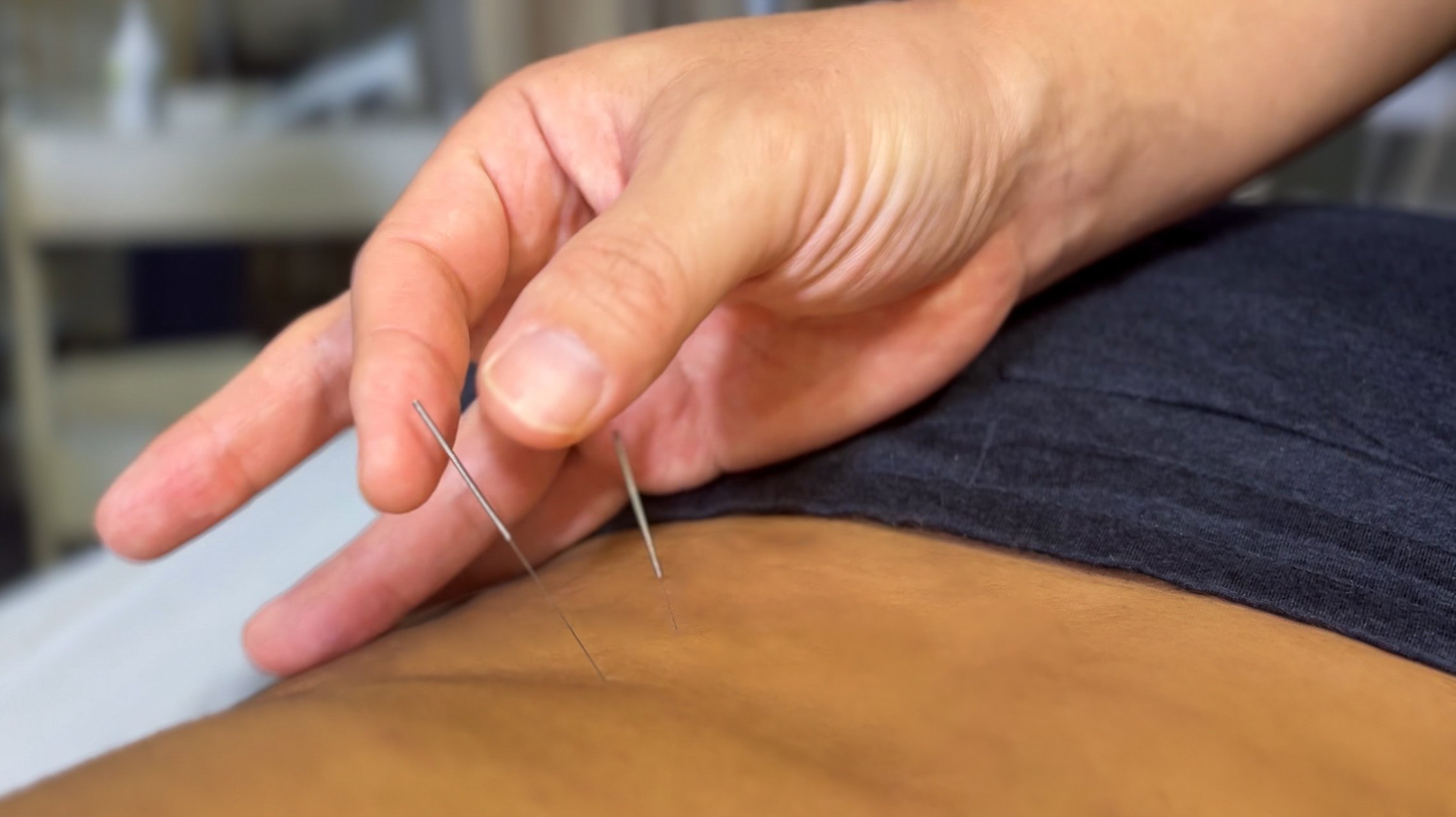 Acupuncture treatment