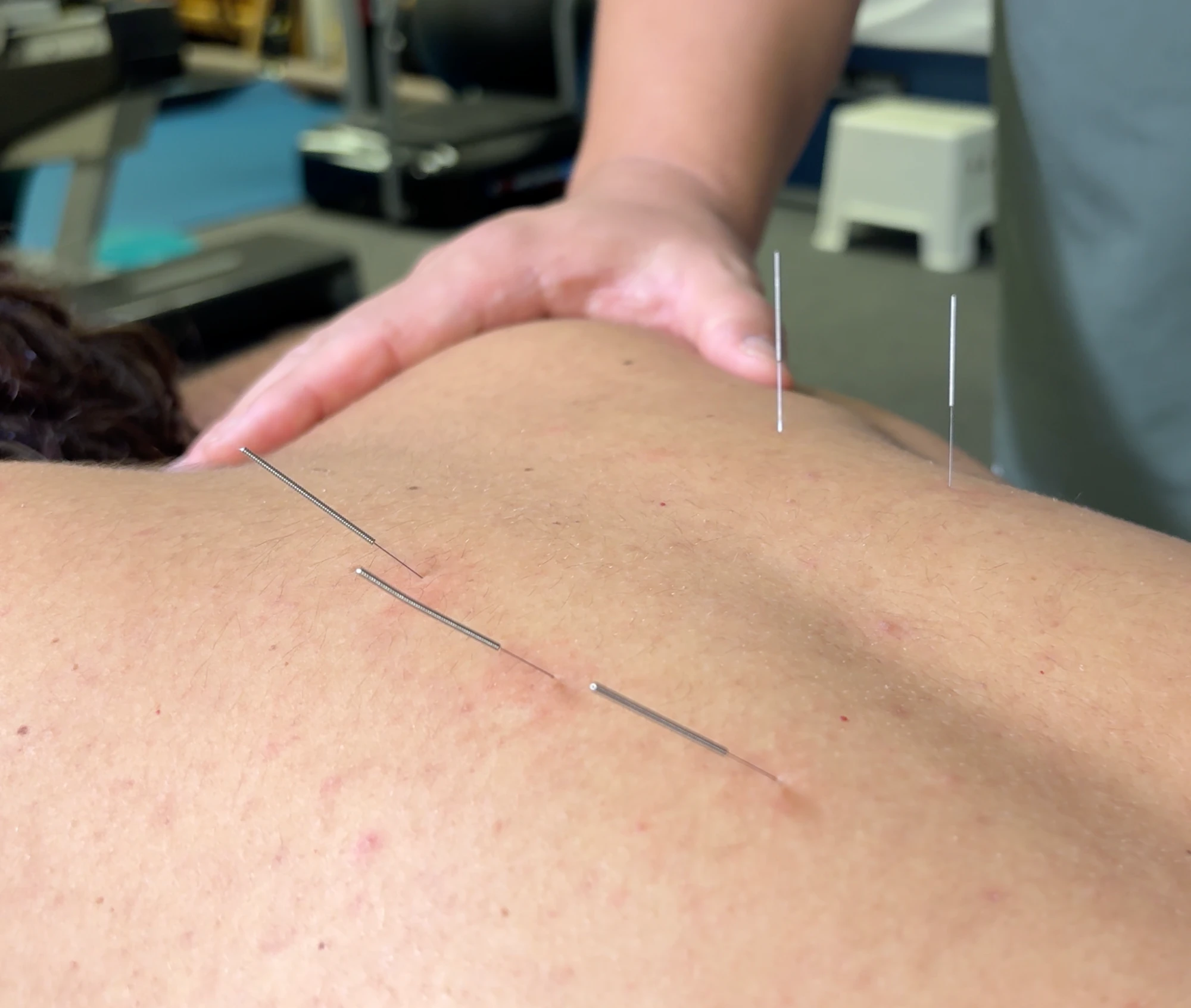 Acupuncture needles in place during a treatment session at Cha PT